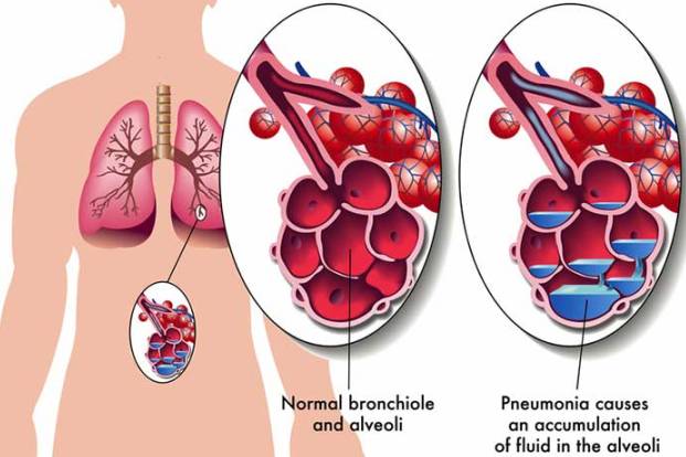 pneumonia_classification